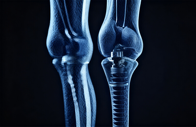 Orthopedic-implants